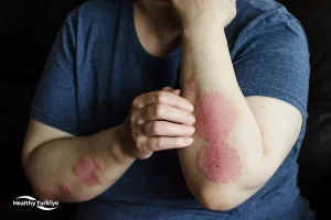 Psoriasis Treatment